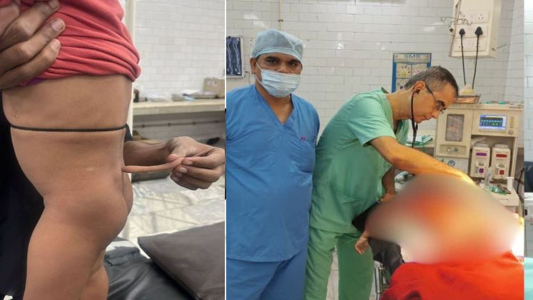 Uttar Pradesh: తోకతో జన్మించిన చిన్నారి.. వయసుతోపాటు అదీ పెరుగుతుండటంతో..