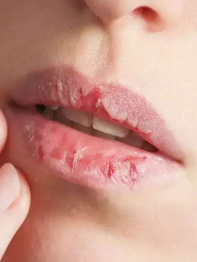 చలికాలంలో చిట్లిన పెదవులకు గుడ్‌బై చెప్పే సింపుల్ టిప్స్ ఇవే !