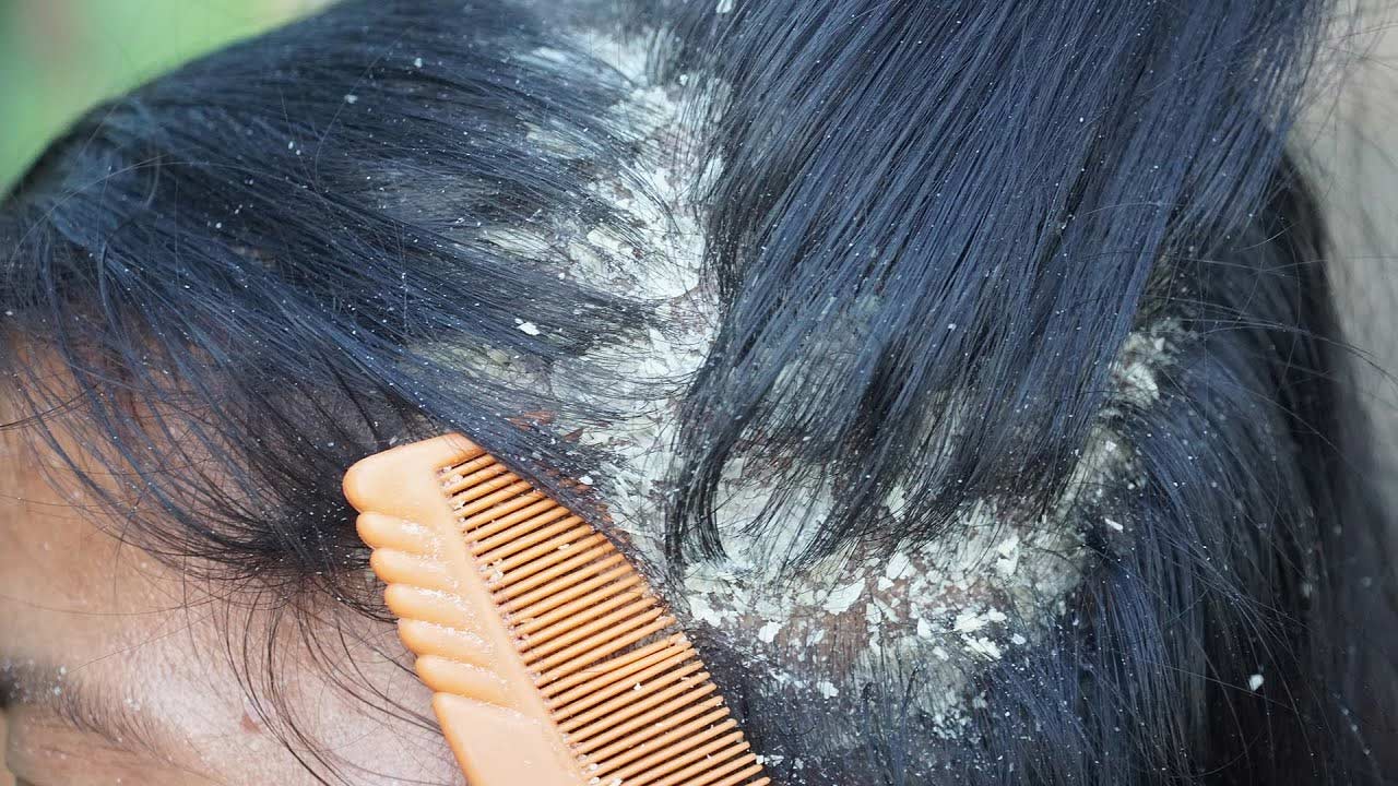 Dandruff Causes: చుండ్రు ఎందుకు వస్తుంది..? ఎలా తగ్గించుకోవాలంటే..