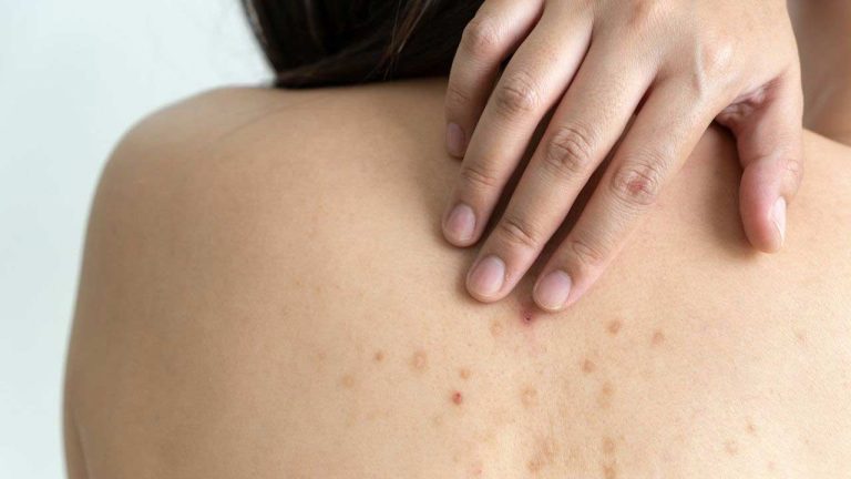 Skin Cancer Symptoms: ఈ లక్షణాలు చర్మ క్యాన్సర్‌కు సంకేతాలు..