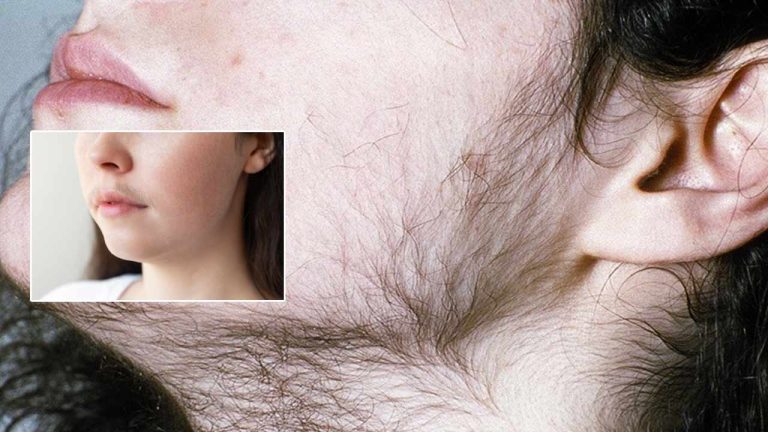 Girls Develop Facial Hair: అమ్మాయిలకు గడ్డాలు, మీసాలు..! ఇలా ఎందుకు జరుగుతుందంటే..?