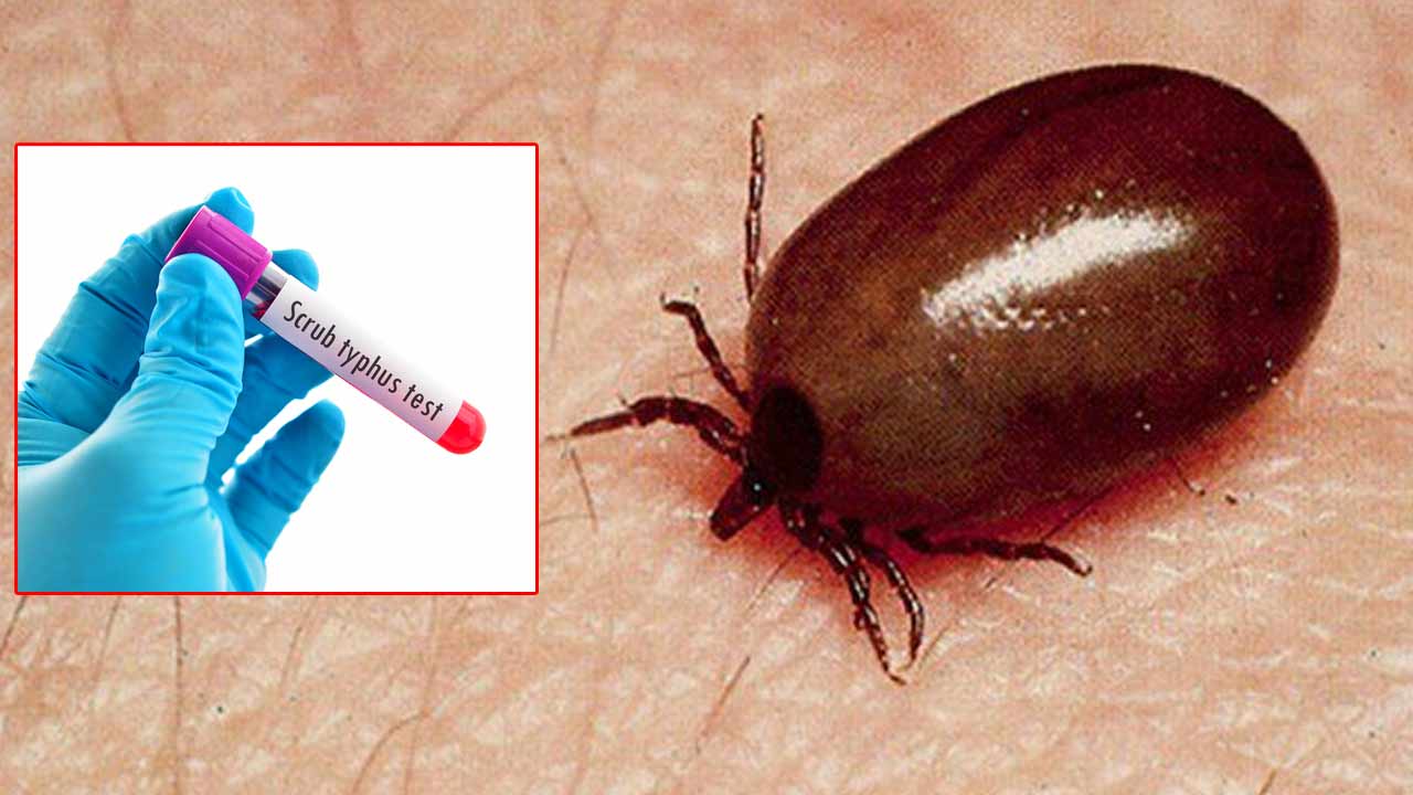 Scrub Typhus: వణికిస్తున్న స్క్రబ్ టైఫస్ వ్యాధి.. డీఎంహెచ్‌వో వివరణ