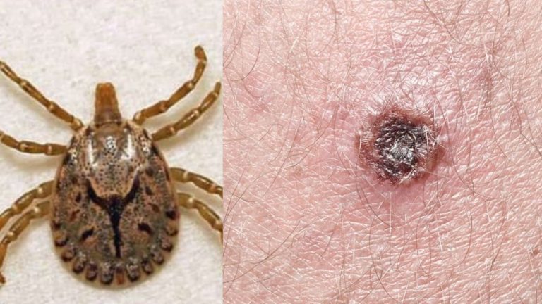Scrub Typhus: స్క్రబ్ టైఫస్ కేసుల విషయంలో ఆందోళన.. నివారణతో ప్రాణాపాయం..