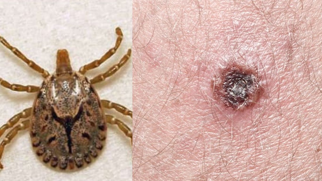 Scrub Typhus: స్క్రబ్ టైఫస్ కేసుల విషయంలో ఆందోళన.. నివారణతో ప్రాణాపాయం..