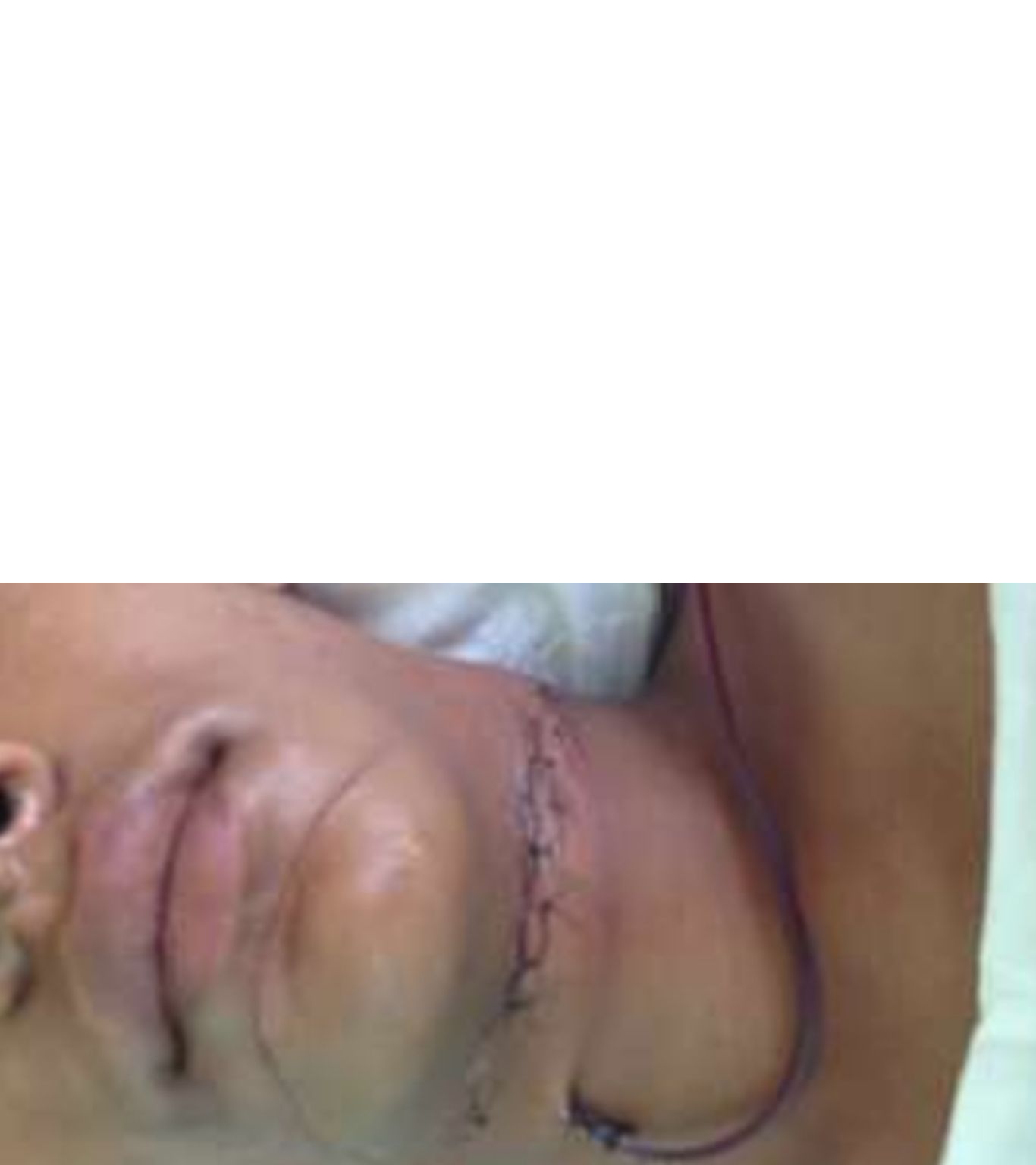 Chinese Manja Accident : దడ పుట్టిస్తున్న చైనా మాంజా.. మెడకు తగిలి యువకుడికి 19 కుట్లు