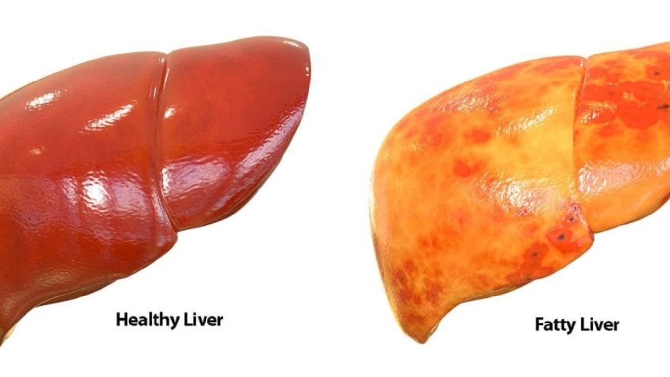 Fatty Liver : మద్యం తాగకపోయినా  ఫ్యాటీ లివర్ ఎందుకు వస్తుందో తెలుసా..