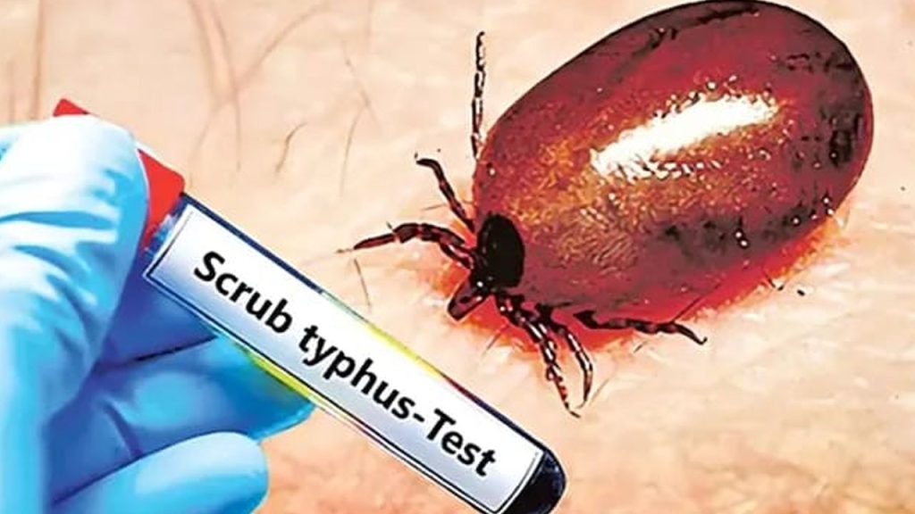 Scrub Typhus