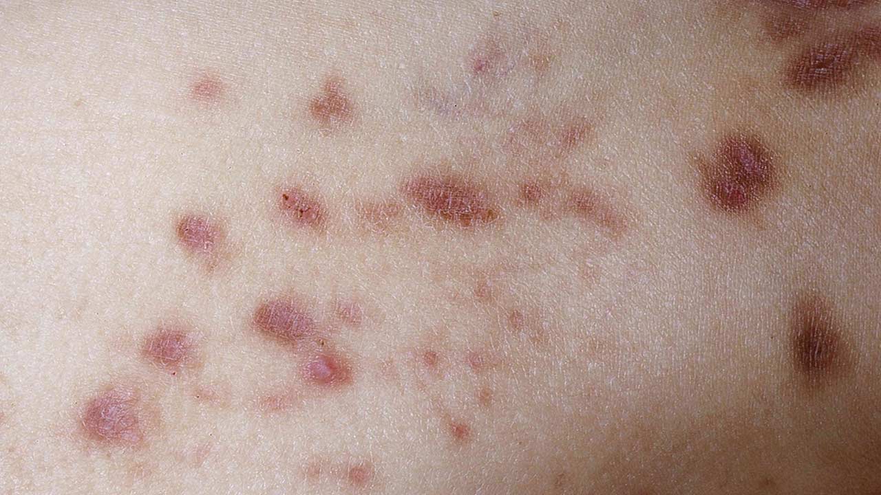 Diabetes Skin Symptoms: మీ శరీరంపై ఇలాంటి మచ్చలు ఉన్నాయా?