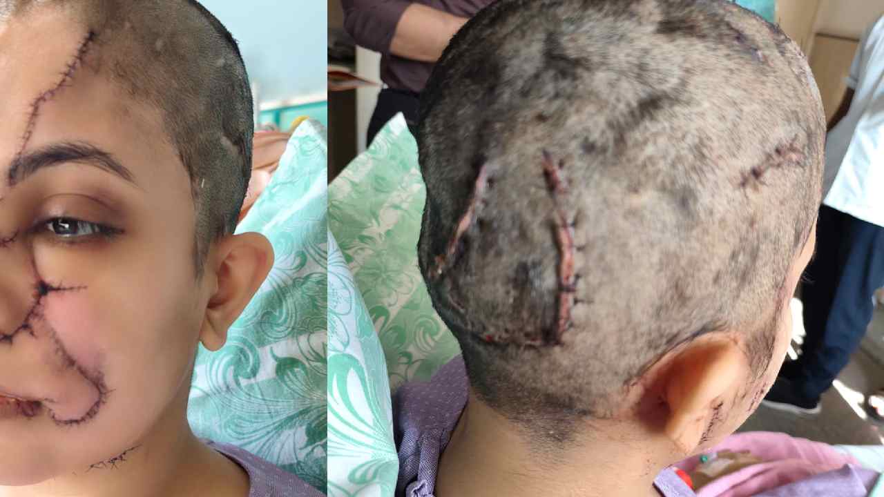 Bengaluru: “డాగ్ లవర్స్” దీనికేం సమాధానం చెబుతారు.. కుక్క దాడితో మహిళకు 50 కుట్లు..