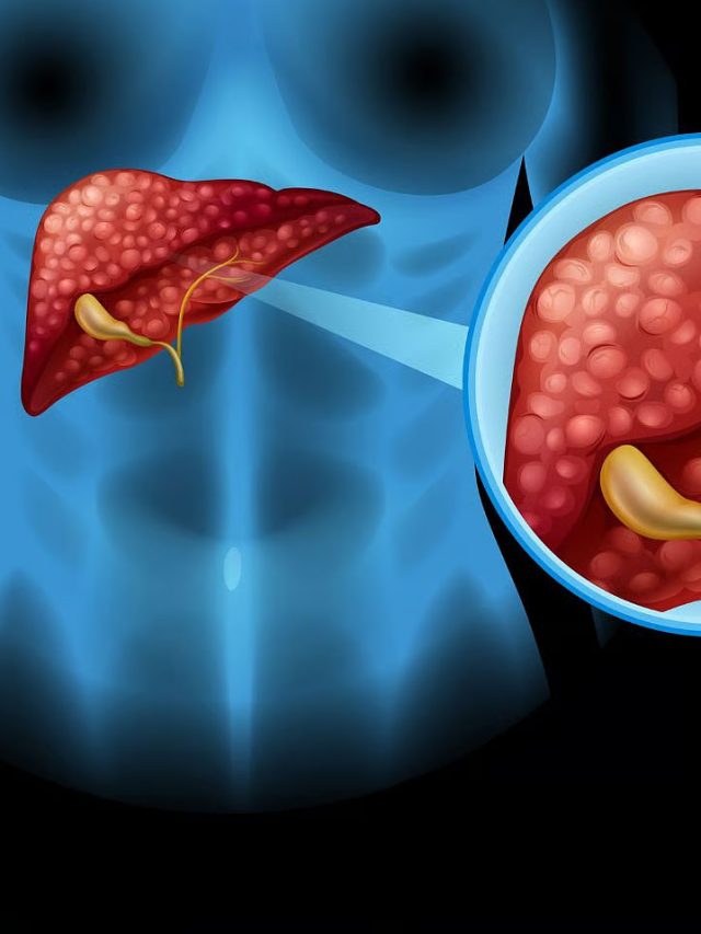 లివర్ ఫ్యాట్ తగ్గాలంటే ఇవి తినండి.. ఇవి మాత్రం మానేయండి!