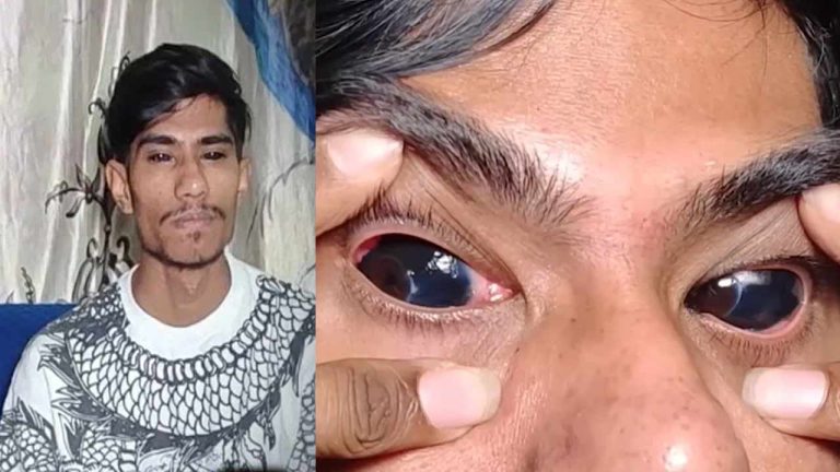 Eyeball Tattoo: పిచ్చికి పరాకాష్ట.. కనుగుడ్లపై టాటూ వేయించుకున్న యువకుడు..