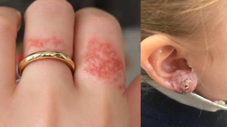 Gold Allergy : బంగారు గొలుసు వేసుకుంటే దురద వస్తోందా? అయితే ఇది చూడాల్సిందే!