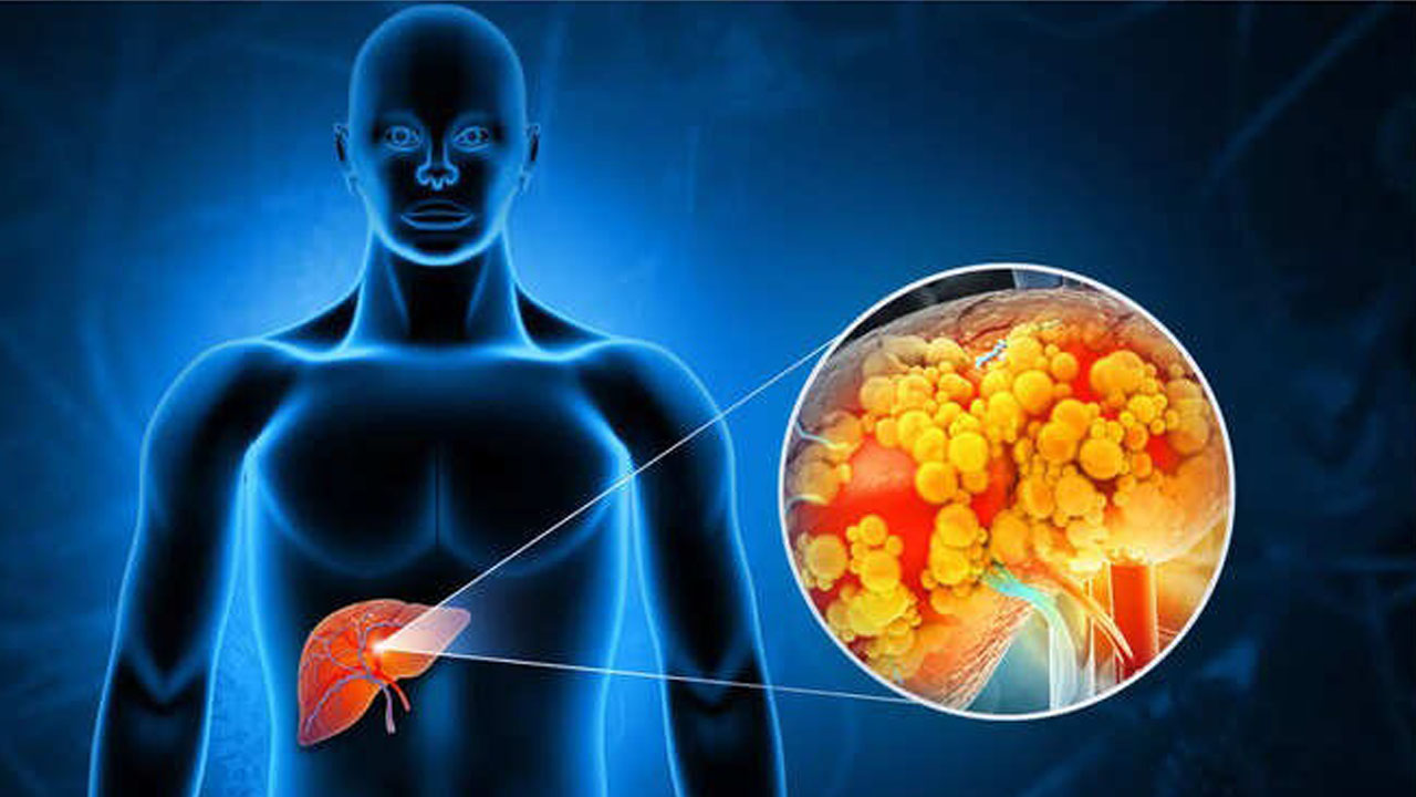 how to reverse fatty liver in 3 months naturally know complete details here