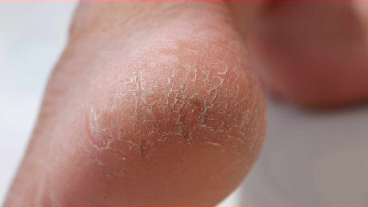 Remedies for Cracked Heels :  మీ పాదాల పగుళ్లకు ఇక చెక్.. ఇంట్లోనే అద్భుతమైన చిట్కాలు.!