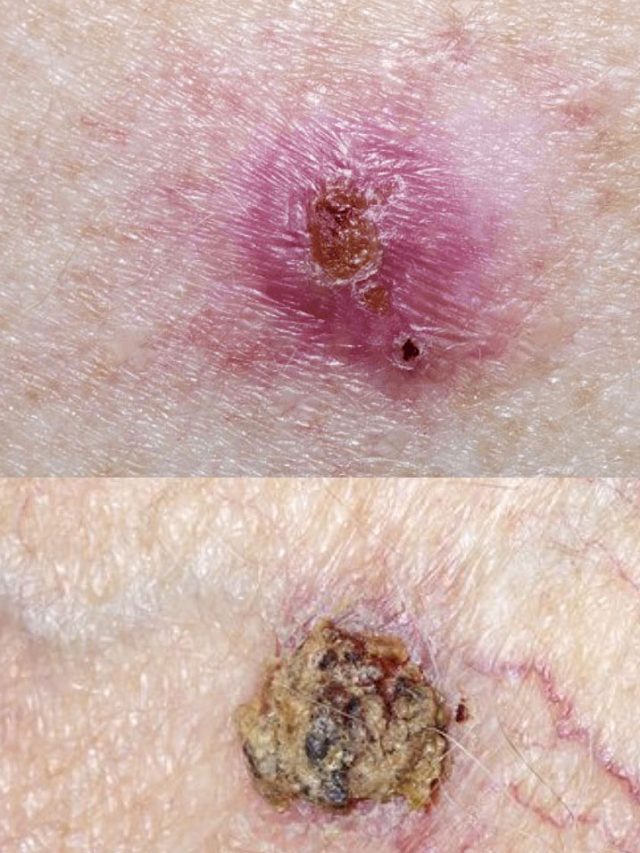 చర్మ క్యాన్సర్‌కి శాశ్వతంగా చెక్ పెట్టే 10 సూపర్ ఫుడ్స్!