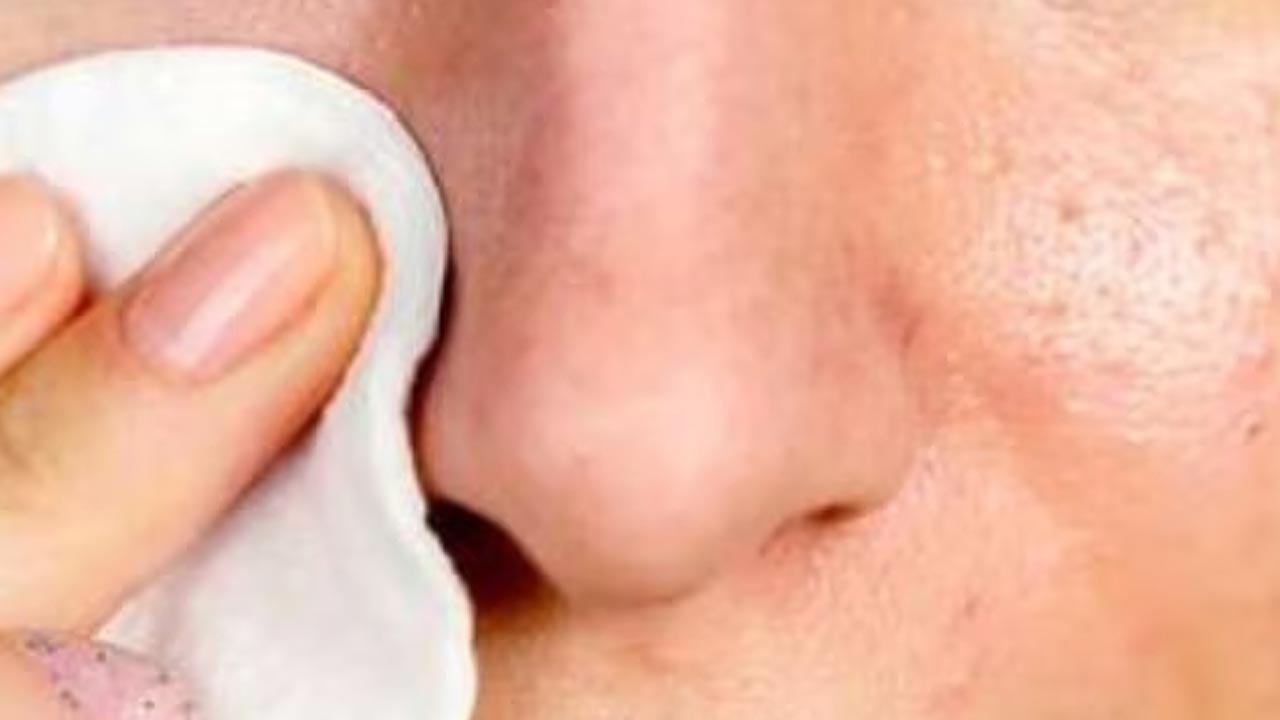 Dark Spots: ముఖంపై నల్లటి మచ్చలా?.. ఈ హోమ్ రెమిడీస్‌తో ప్రాబ్లం క్లియర్!