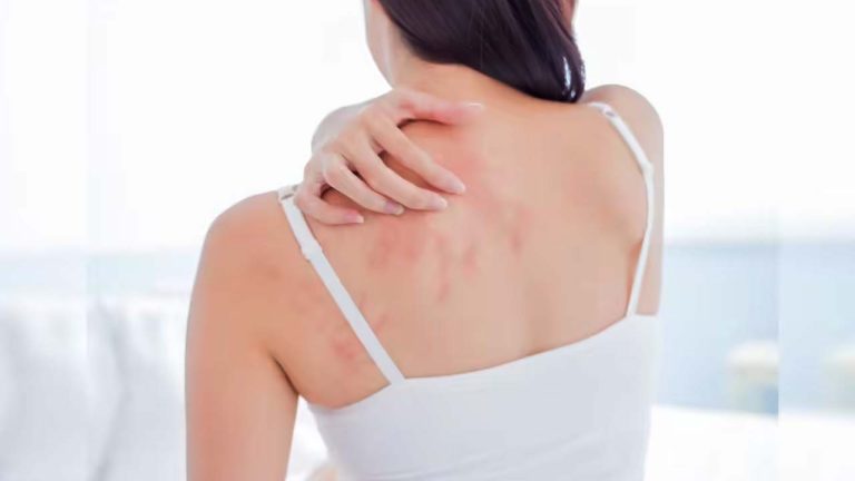 Summer Skin Itching Remedies : వేసవిలో చెమట దురదకు సింపుల్ సొల్యూషన్.! 2 నిమిషాల్లో రిలీఫ్.!