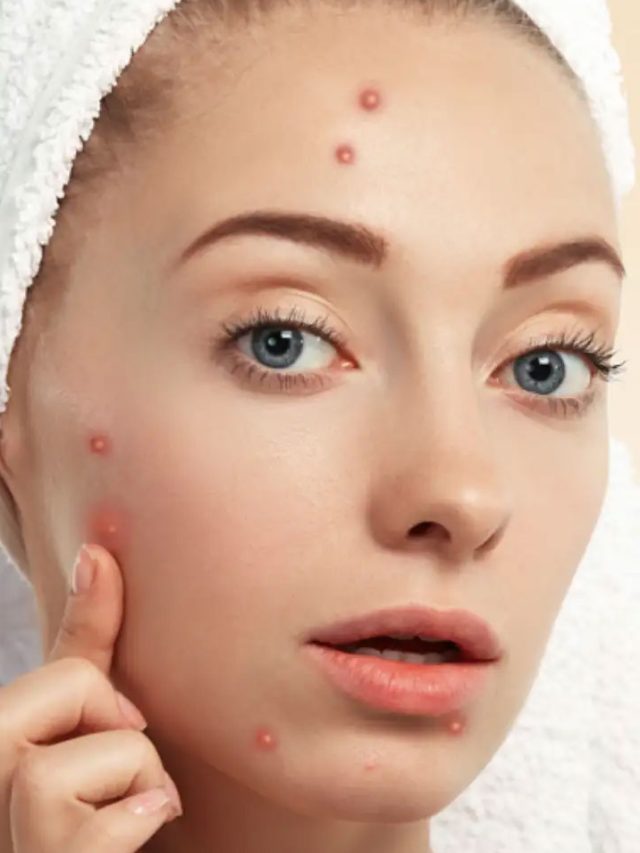 పింపుల్స్ రావడం ఆపాలంటే… ఇవే బెస్ట్ సొల్యూషన్స్!