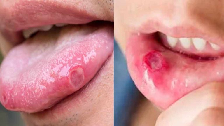 Mouth Ulcer Causes: నోటి పూత తగ్గడం లేదా? ఈ లక్షణాలను అస్సలు నిర్లక్ష్యం చేయొద్దు.. డాక్టర్ల హెచ్చరిక