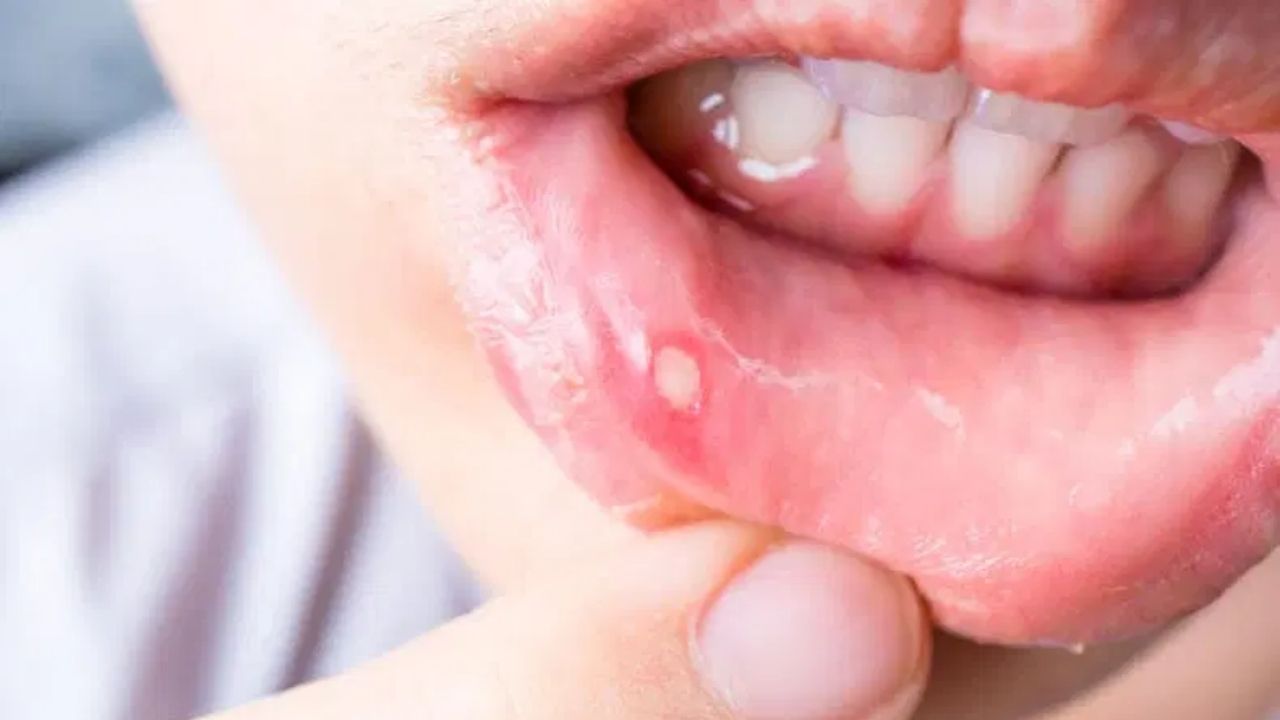 Mouth Ulcer: చిన్న నోటిపుండే కదా అని లైట్ తీసుకుంటున్నారా? ఈ మార్పులు కనిపిస్తే తప్పక డాక్టర్‌ను సంప్రదించాల్సిందే.!