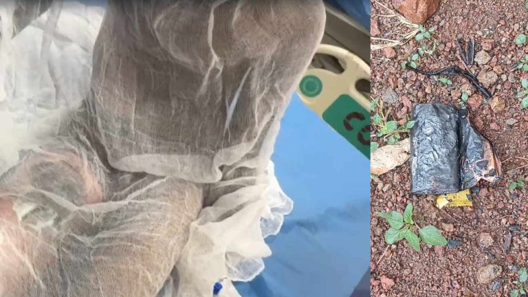 Power Bank Explosion : పవర్ బ్యాంక్ పేలి విద్యార్థికి తీవ్ర గాయాలు